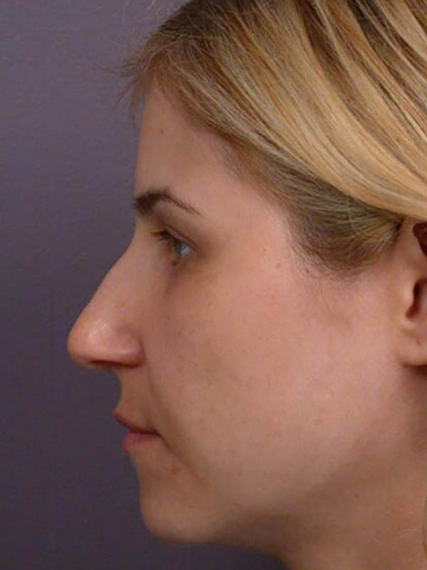 Rhinoplasty Before & After Image