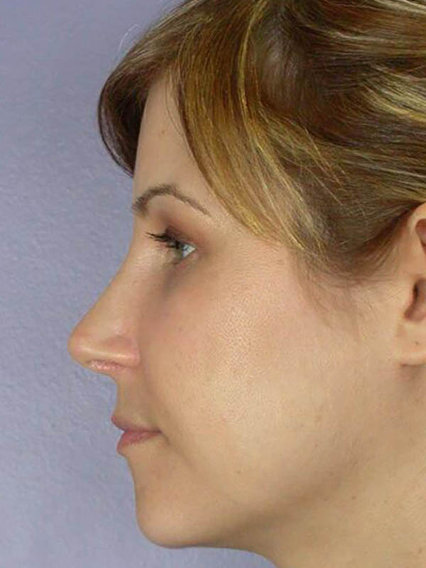 Rhinoplasty Before & After Image