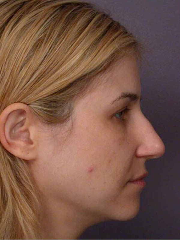 Rhinoplasty Before & After Image