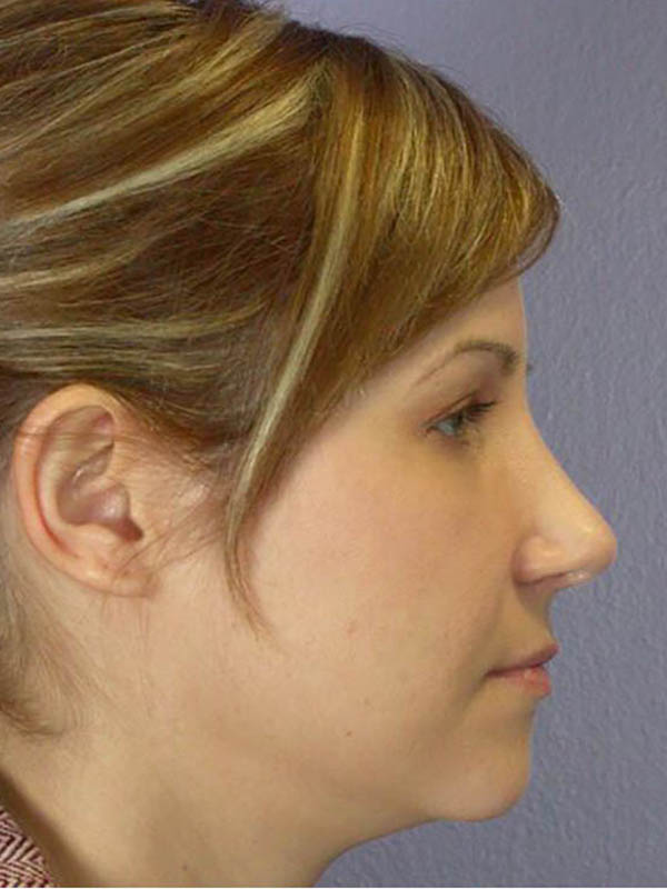 Rhinoplasty Before & After Image