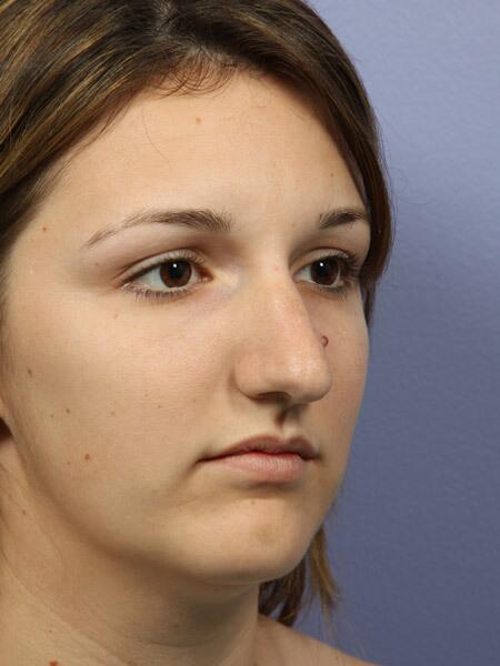 Rhinoplasty Before & After Image