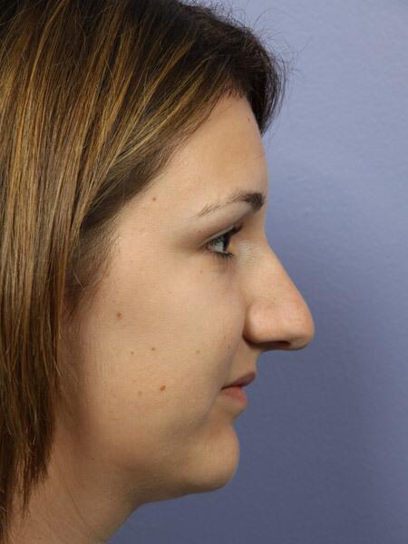 Rhinoplasty Before & After Image