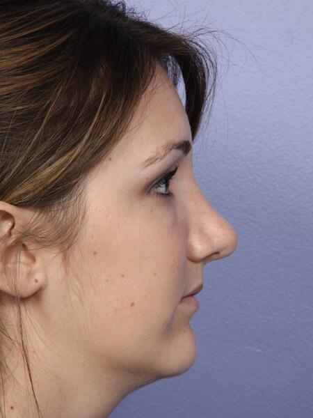 Rhinoplasty Before & After Image