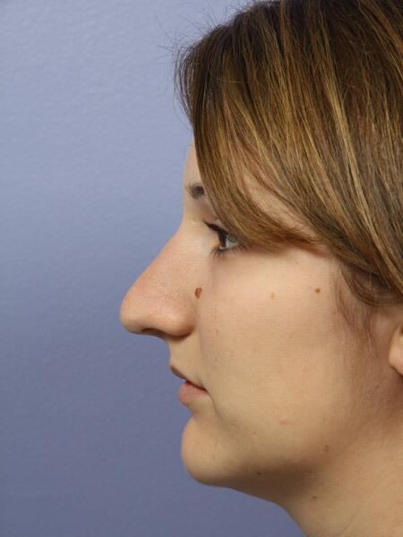 Rhinoplasty Before & After Image