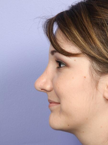 Rhinoplasty Before & After Image