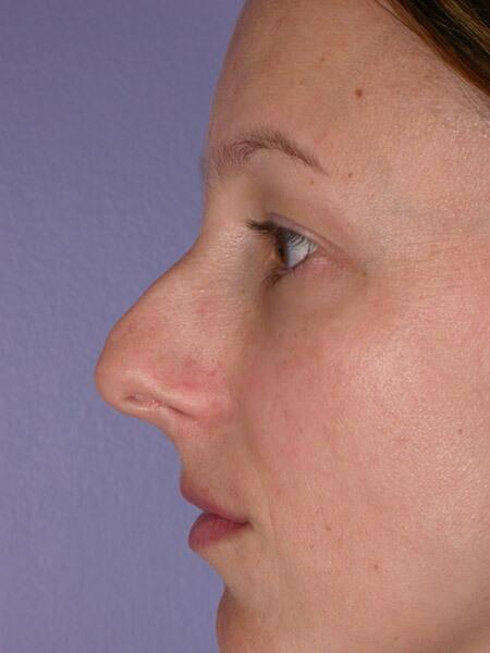 Rhinoplasty Before & After Image