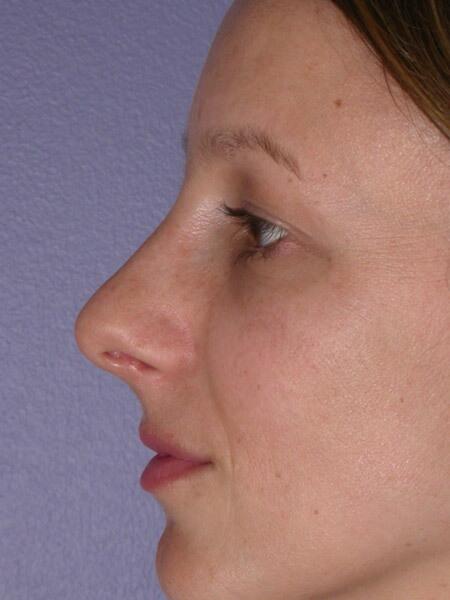 Rhinoplasty Before & After Image