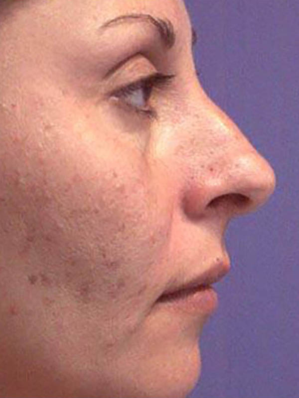 Rhinoplasty Before & After Image