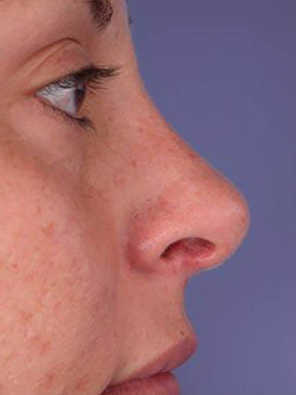 Rhinoplasty Before & After Image