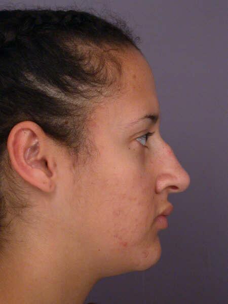 Rhinoplasty Before & After Image