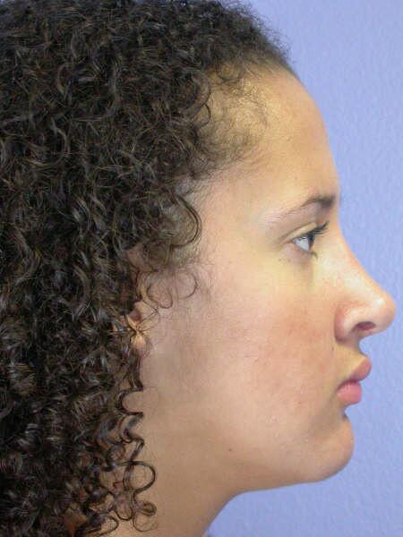 Rhinoplasty Before & After Image