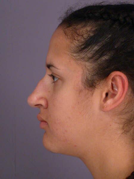 Rhinoplasty Before & After Image