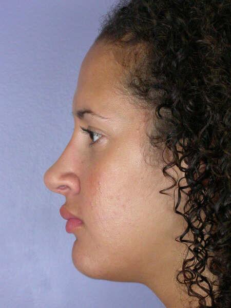 Rhinoplasty Before & After Image