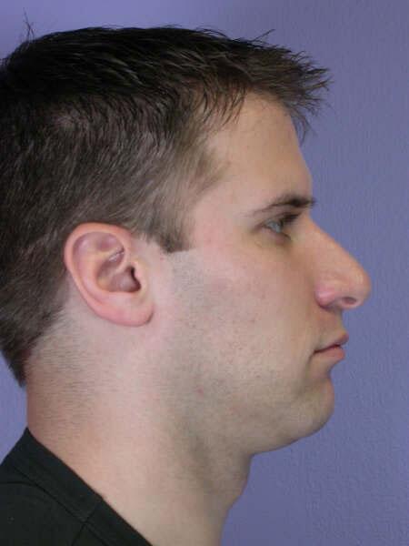 Rhinoplasty Before & After Image