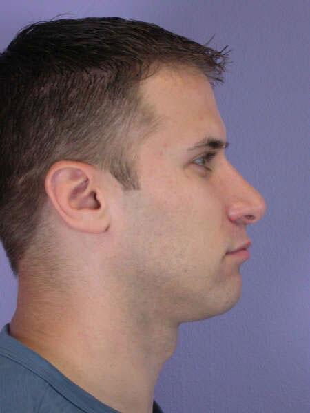 Rhinoplasty Before & After Image