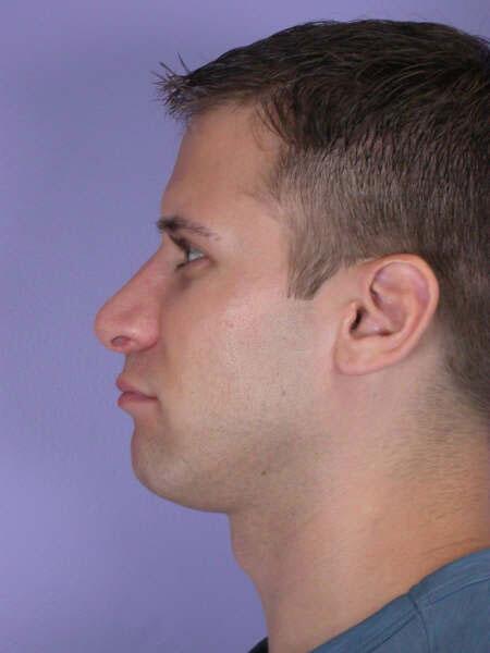 Rhinoplasty Before & After Image