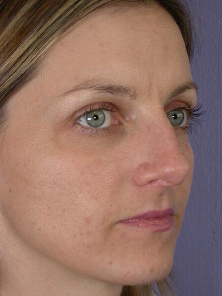 Rhinoplasty Before & After Image