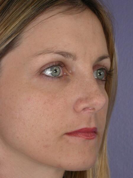 Rhinoplasty Before & After Image