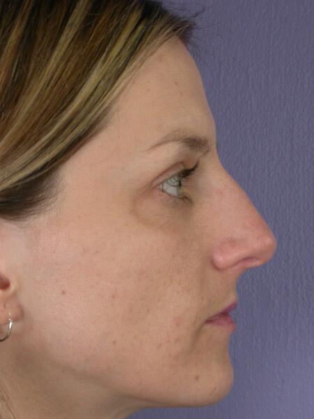 Rhinoplasty Before & After Image