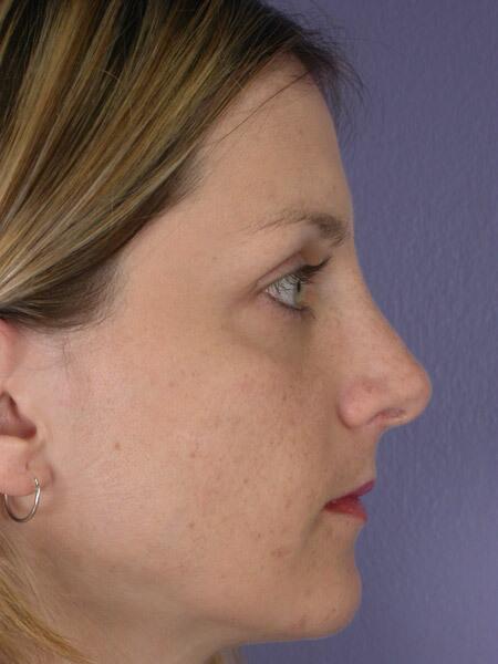 Rhinoplasty Before & After Image