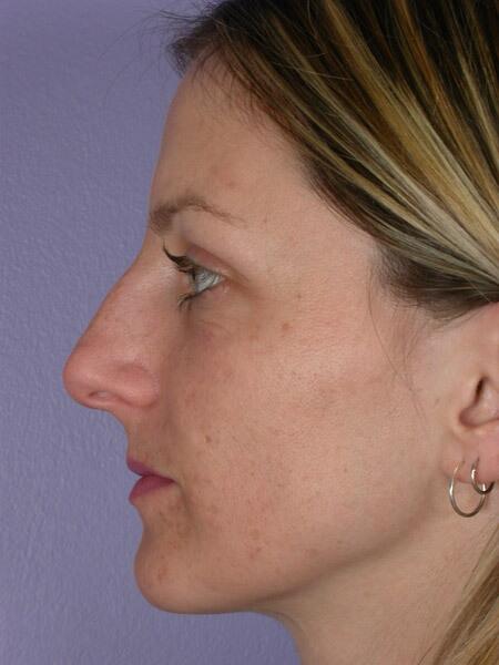 Rhinoplasty Before & After Image