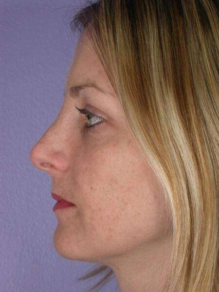 Rhinoplasty Before & After Image