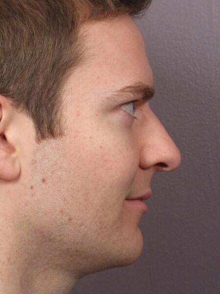 Rhinoplasty Before & After Image