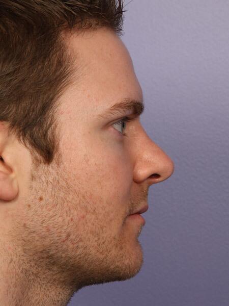 Rhinoplasty Before & After Image