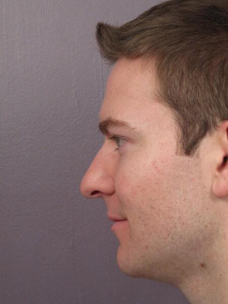 Rhinoplasty Before & After Image