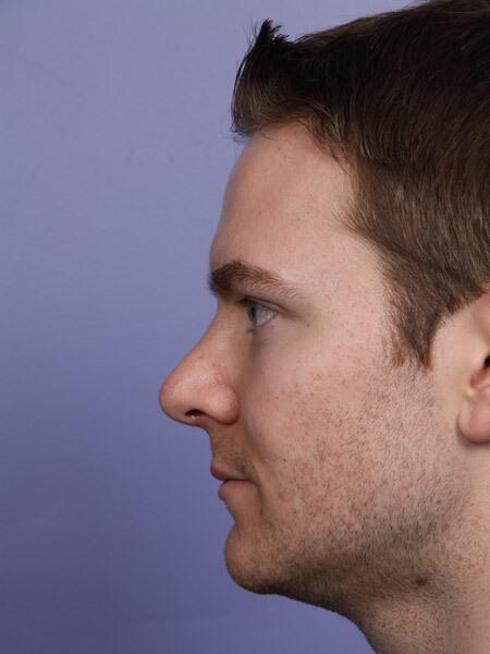 Rhinoplasty Before & After Image