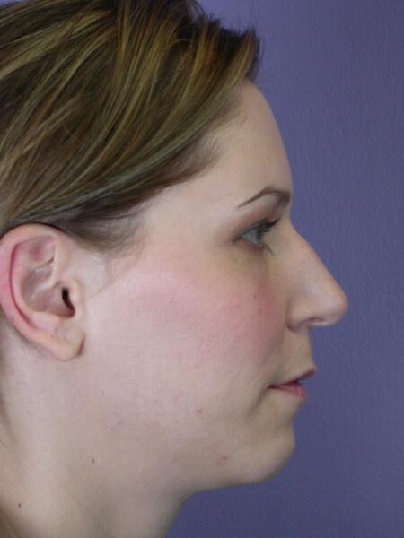 Rhinoplasty Before & After Image