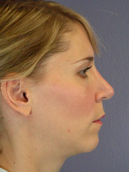 Rhinoplasty Before & After Image