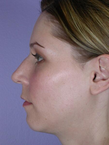 Rhinoplasty Before & After Image