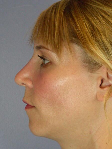 Rhinoplasty Before & After Image