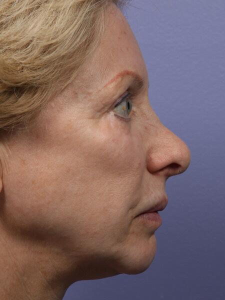 Rhinoplasty Before & After Image