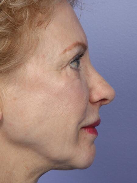 Rhinoplasty Before & After Image