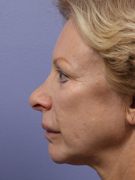 Rhinoplasty Before & After Image