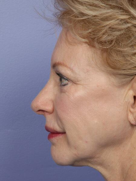 Rhinoplasty Before & After Image