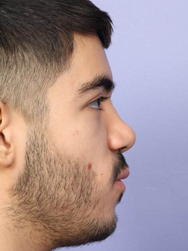 Rhinoplasty Before & After Image