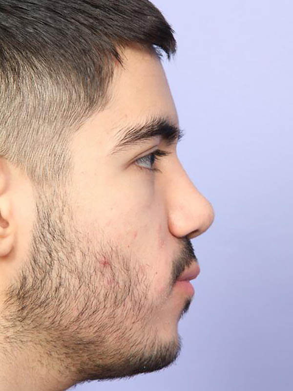 Rhinoplasty Before & After Image