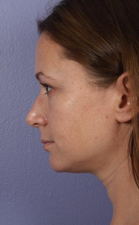 Rhinoplasty Before & After Image