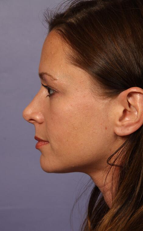 Rhinoplasty Before & After Image