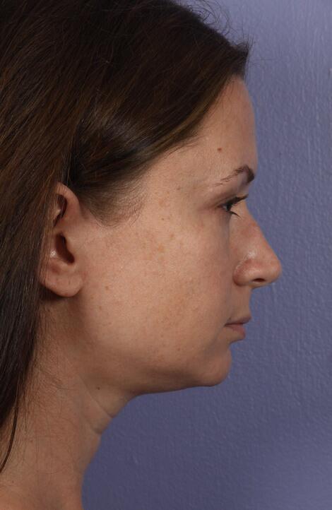 Rhinoplasty Before & After Image