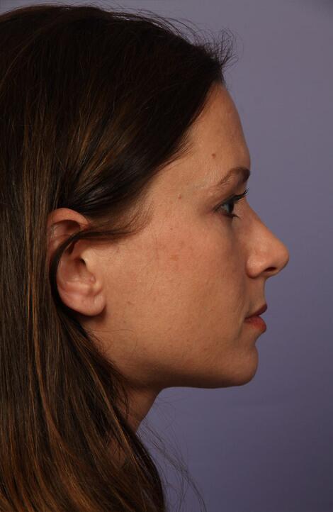 Rhinoplasty Before & After Image