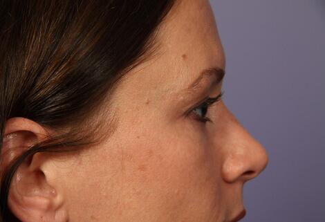 Rhinoplasty Before & After Image