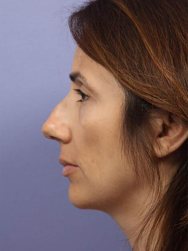 Rhinoplasty Before & After Image