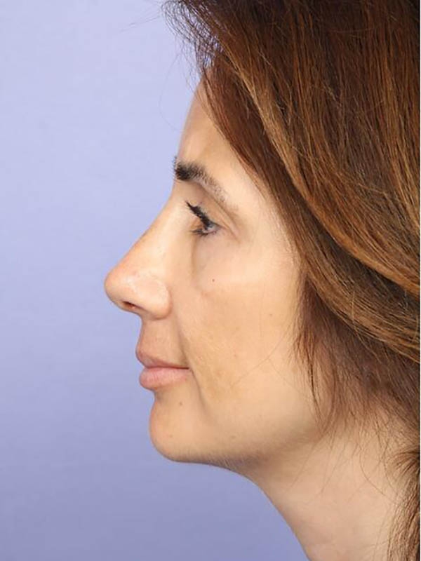 Rhinoplasty Before & After Image