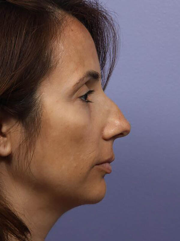 Rhinoplasty Before & After Image