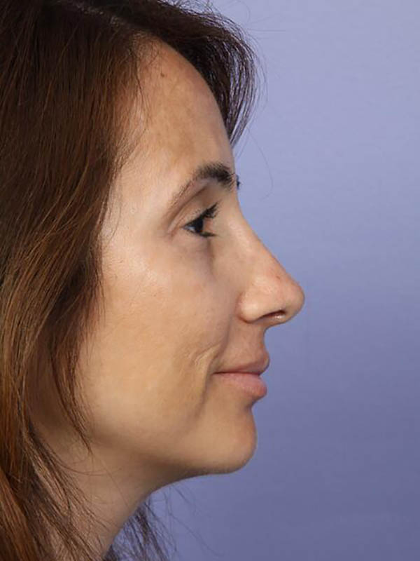 Rhinoplasty Before & After Image