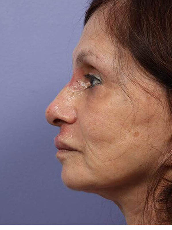 Rhinoplasty Before & After Image